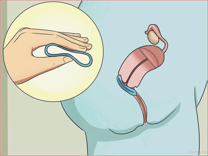 Новаринг — отзывы девушек о вагинальном кольце Nuvaring, Bewertungen, Mädchen, vaginal, Ring